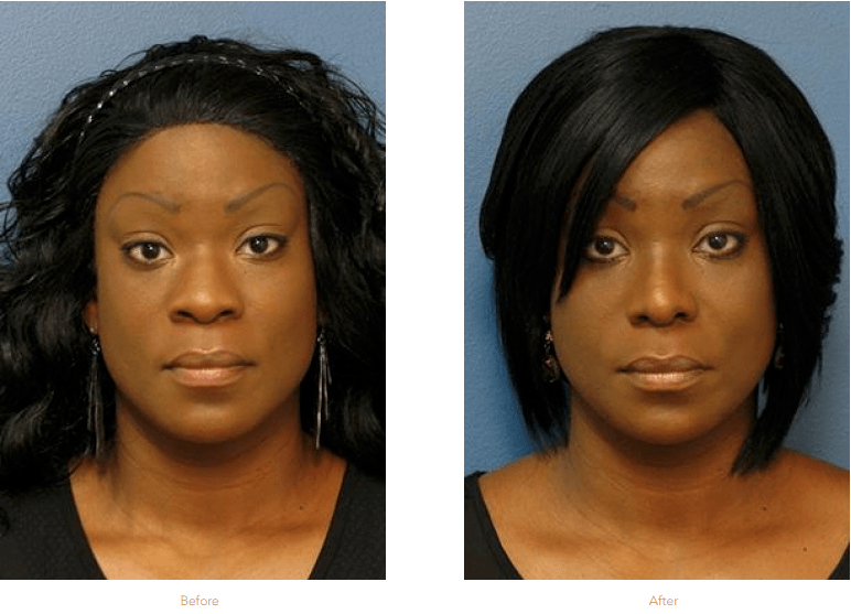 Best Ethnic Rhinoplasty Surgeon NYC