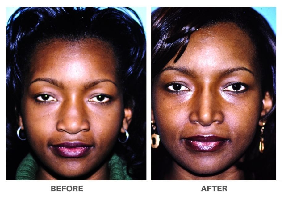 Affordable Ethnic Rhinoplasty NYC Cost
