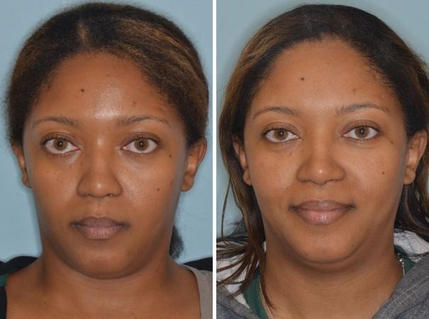 Ethnic Rhinoplasty in New York, NY