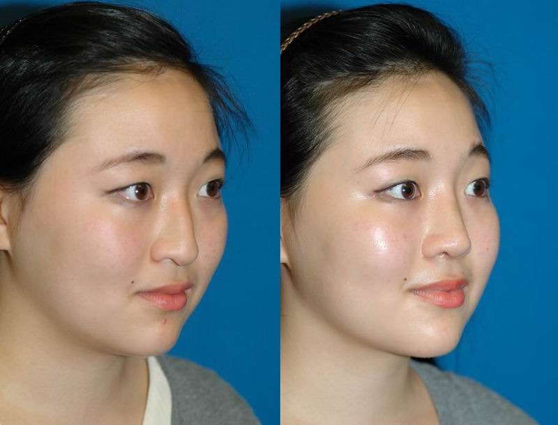 Affordable Ethnic Rhinoplasty New York City 