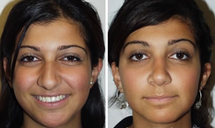 Ethnic Rhinoplasty Financing New York City