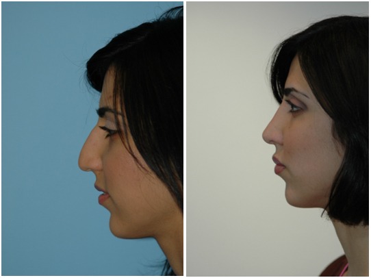 Manhattan Ethnic Rhinoplasty Cost