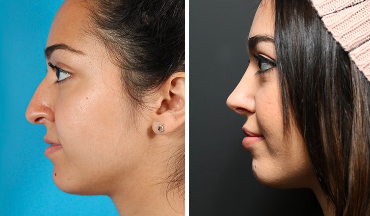 Affordable Ethnic Rhinoplasty NYC