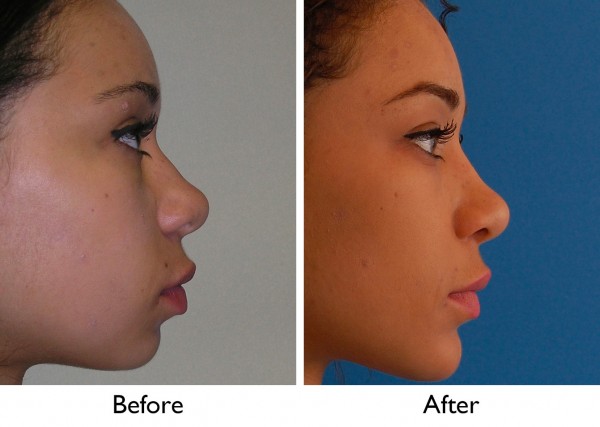 Ethnic Rhinoplasty Pricing New York City
