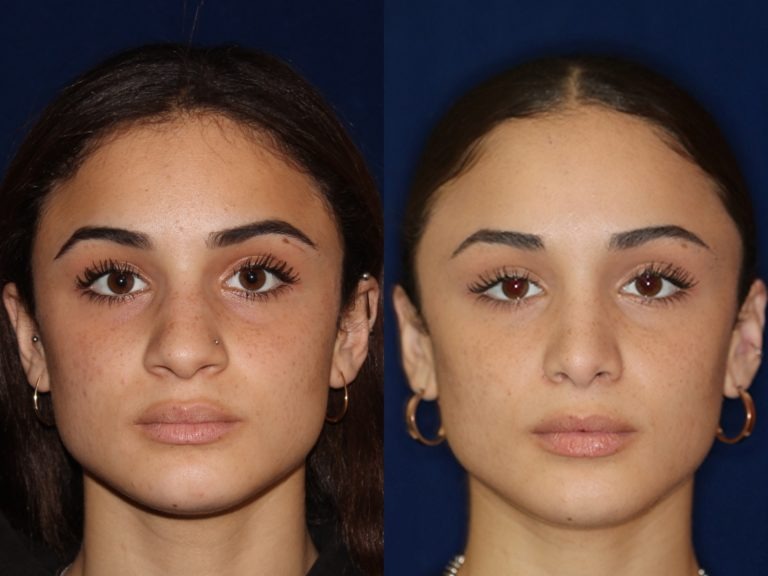 Ethnic Rhinoplasty Cost New York City