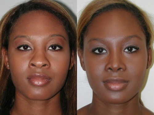 Affordable African American Rhinoplasty Manhattan