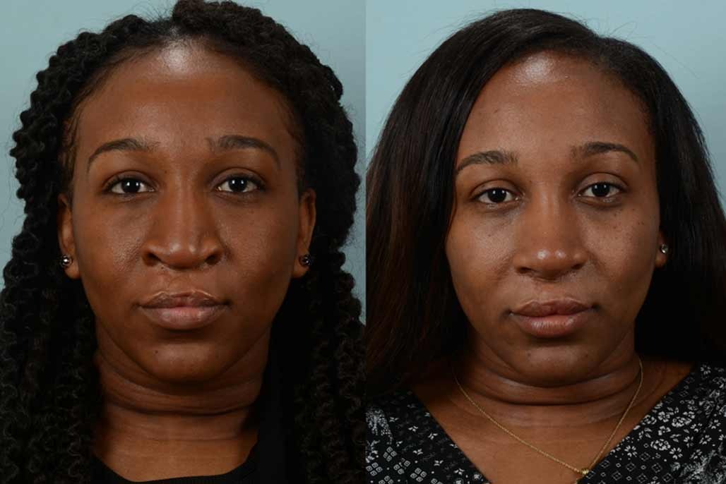 african american rhinoplasty cost new york city