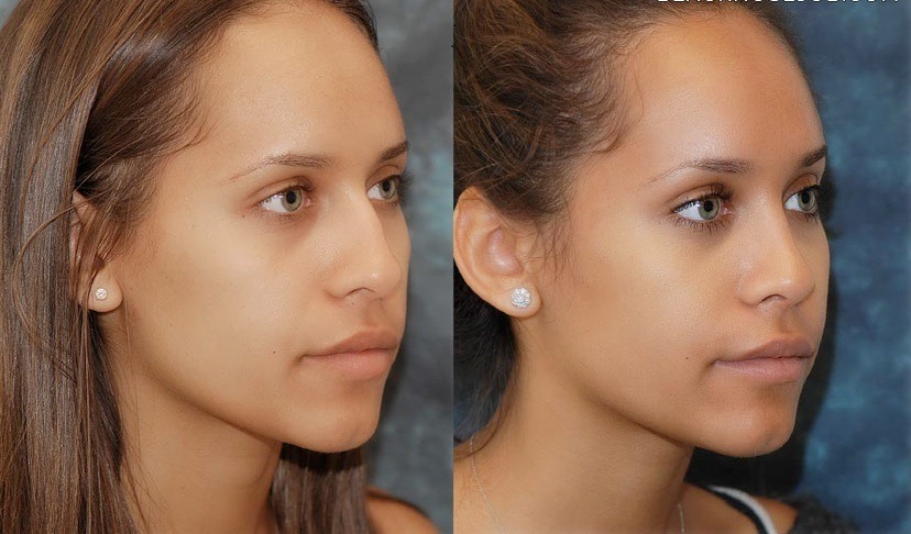 Affordable African American Rhinoplasty Manhattan, NY